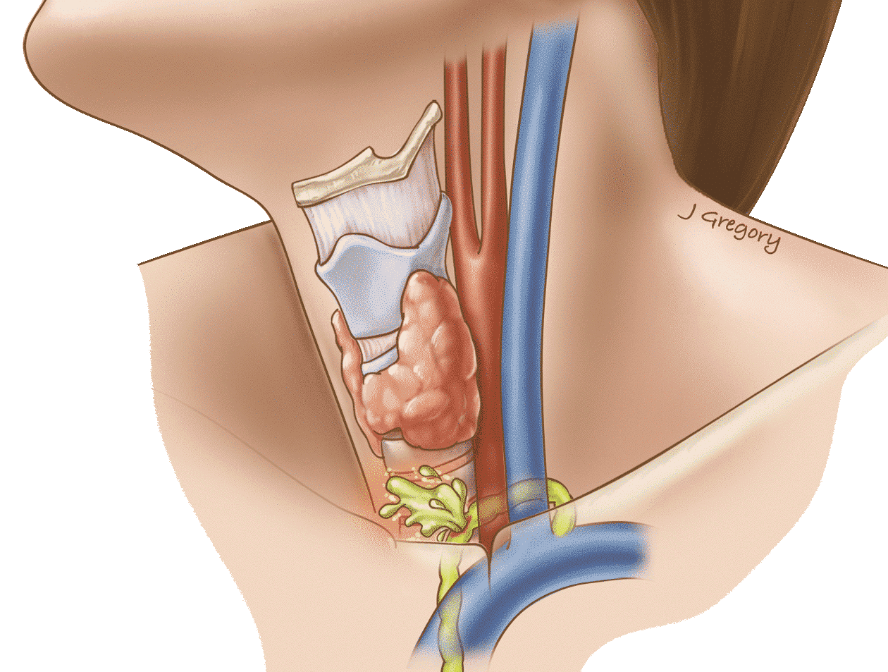 Cáncer medular de tiroides - Cáncer de tiroides