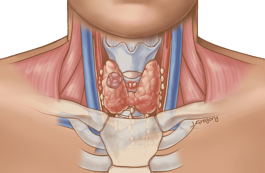 Cáncer de tiroides anaplásico - Cáncer de tiroides