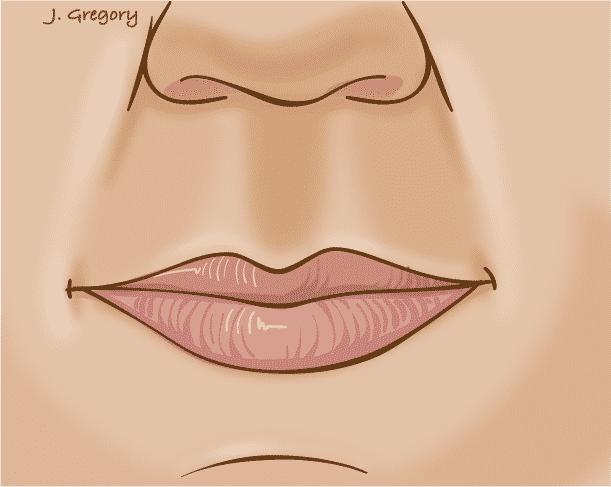 Lips - Oral cancer