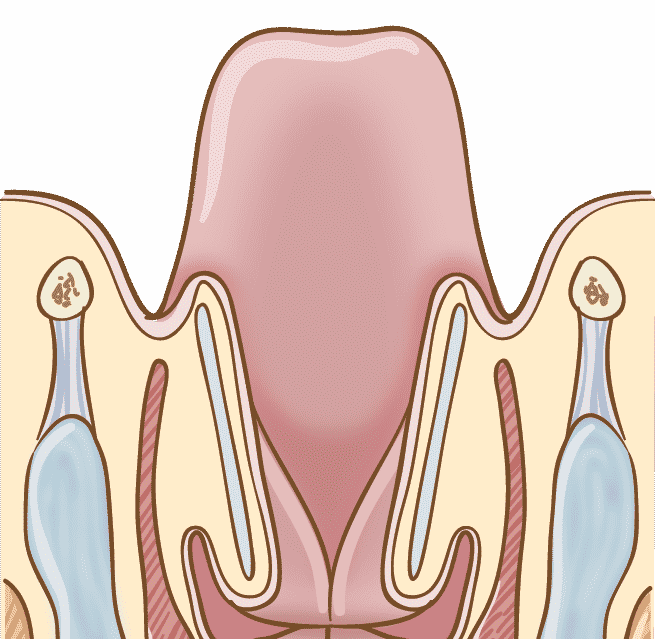 Laryngeal cancer - Larynx