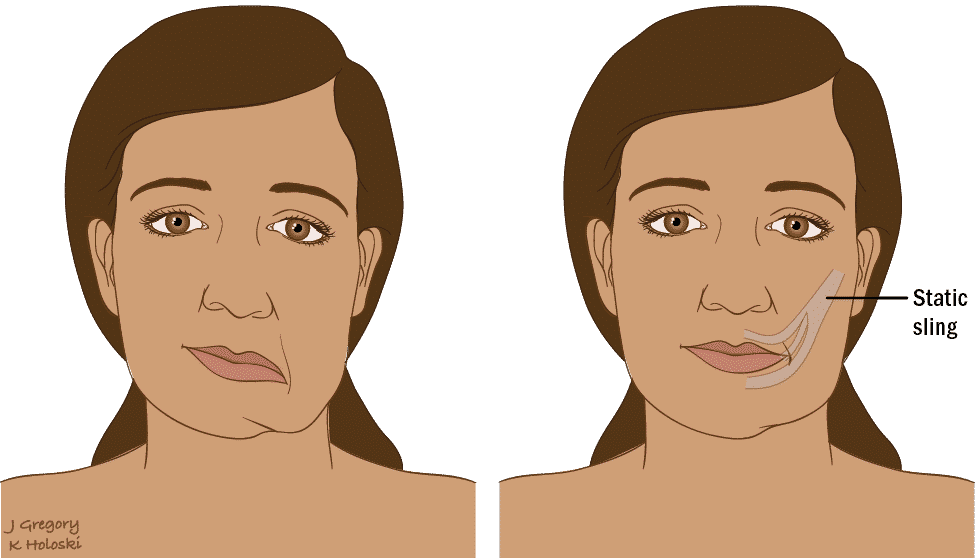 Cara - Parálisis del nervio facial