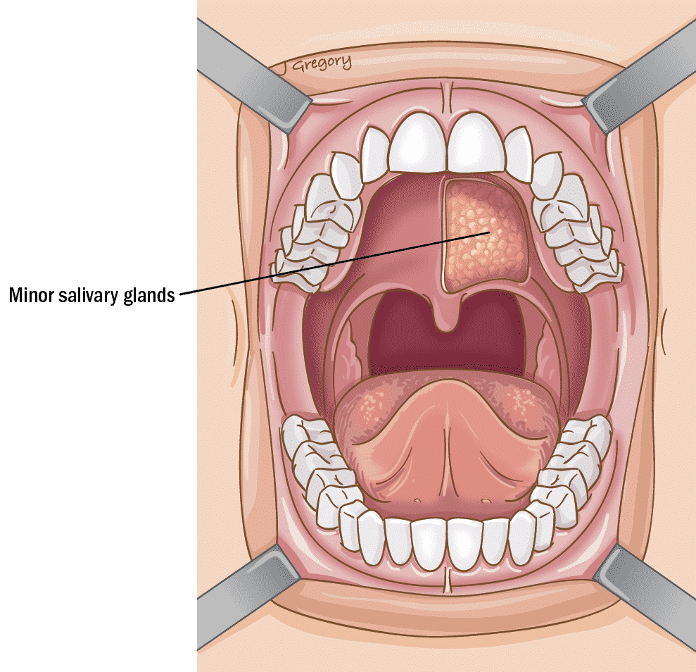 Ilustración de la boca señalando las glándulas salivales menores en el paladar.