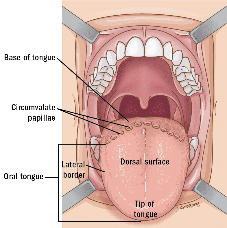 Tongue Cancer ‣ THANC Guide