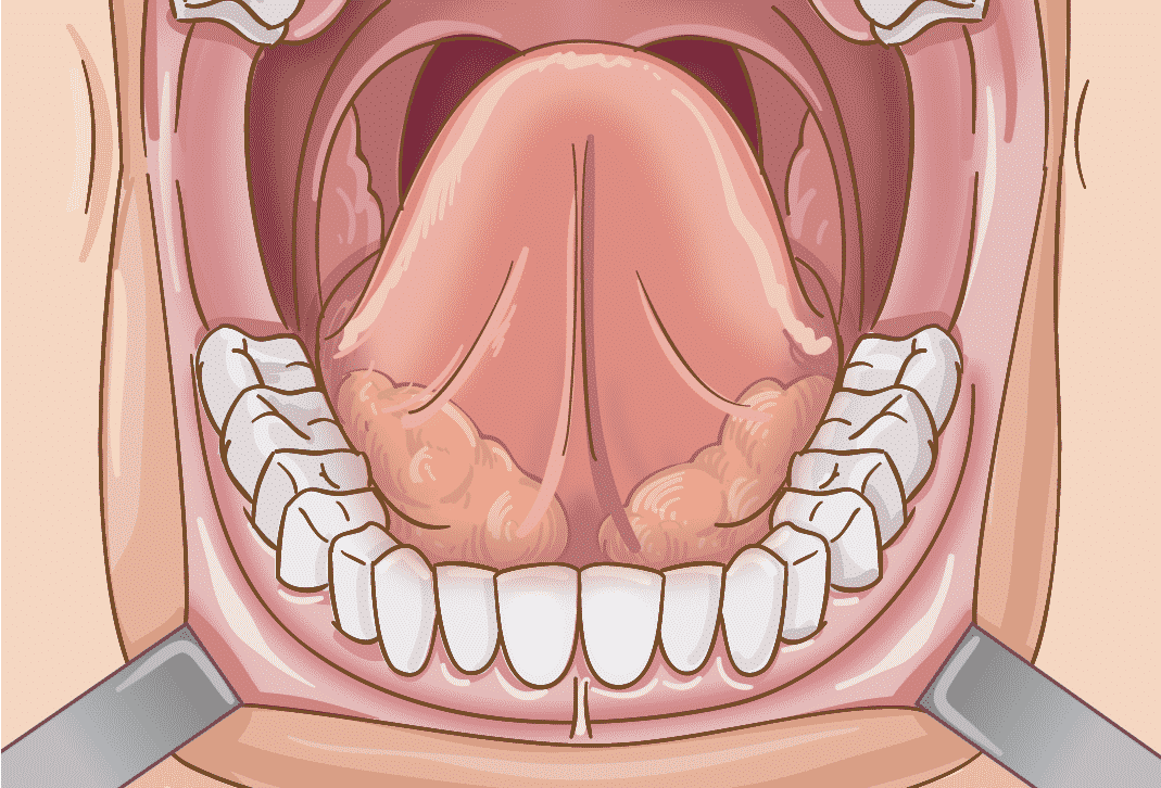 Tumor de la glándula salival - Glándula salival