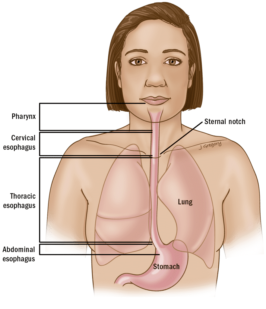Esophagus - Esophageal cancer