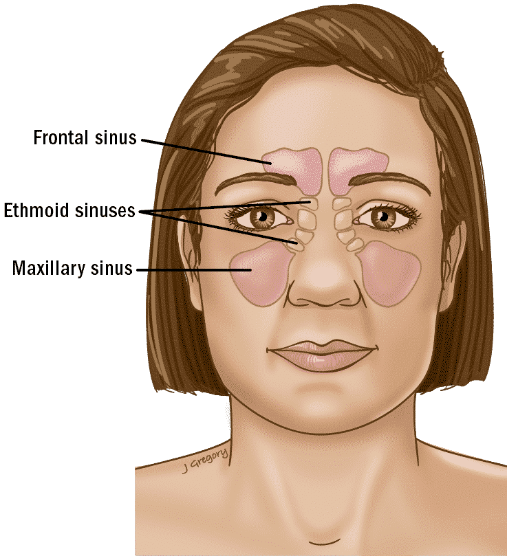 Cáncer nasal y de los senos paranasales - Sinusitis