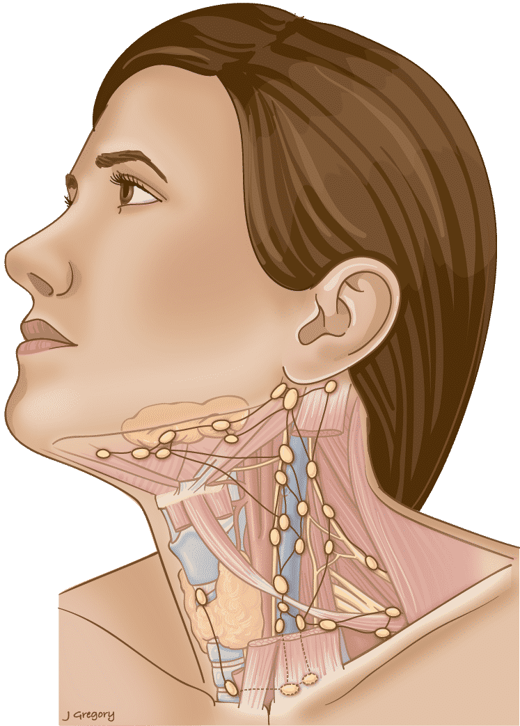 Cáncer de cabeza y cuello - Ganglio linfático