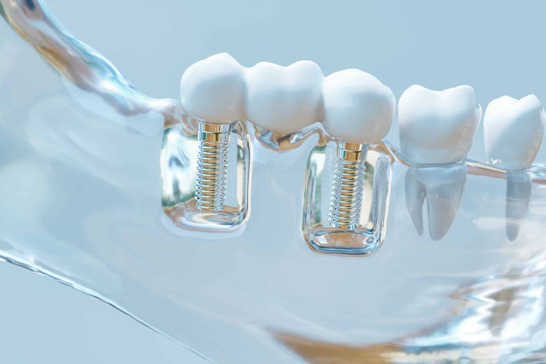 Implante dental - Odontología