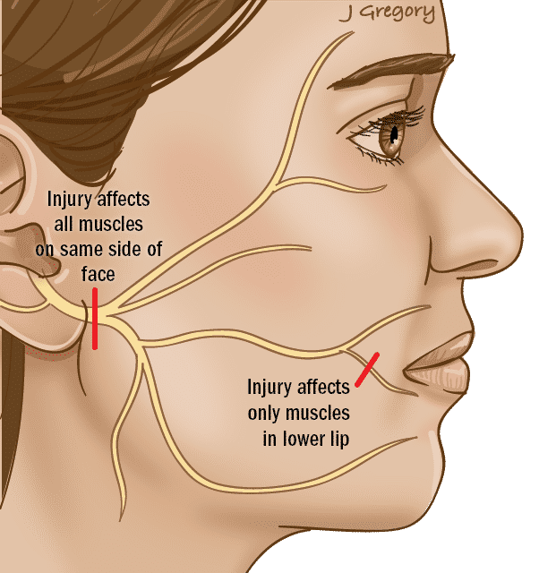 Parotidectomy - Nerve