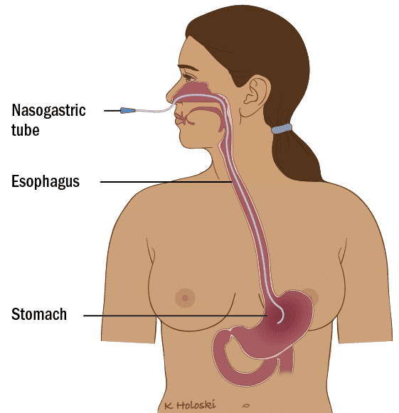 Sonda de alimentación - Intubación nasogástrica
