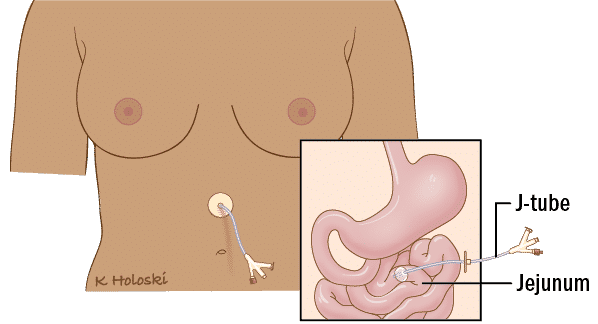Sonda de alimentación - Gastrostomía endoscópica percutánea