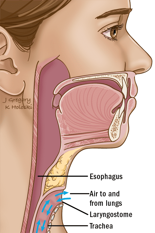 Laryngeal cancer - Laryngectomy
