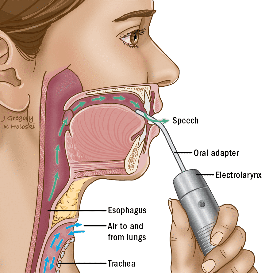 electrolarynx, oral adapter, speech, esophagus, airway, trachea