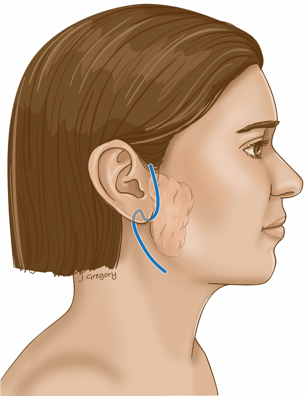 Parotidectomía - Cirugía