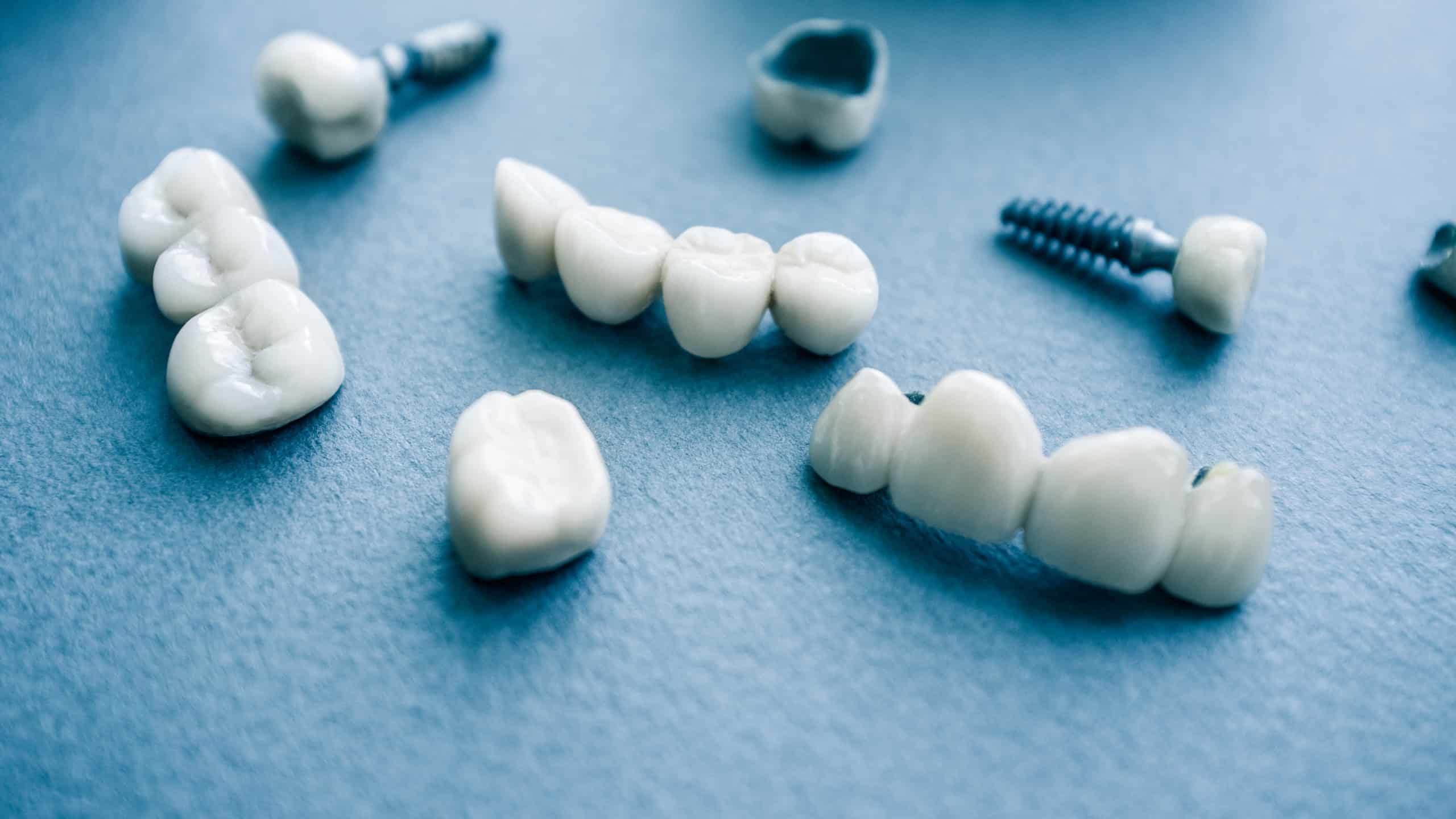 Implante dental - Odontología