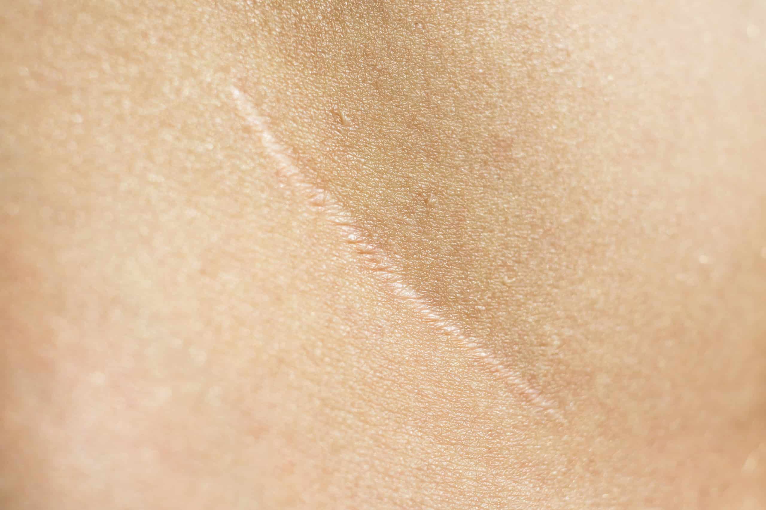 Skin - Scar