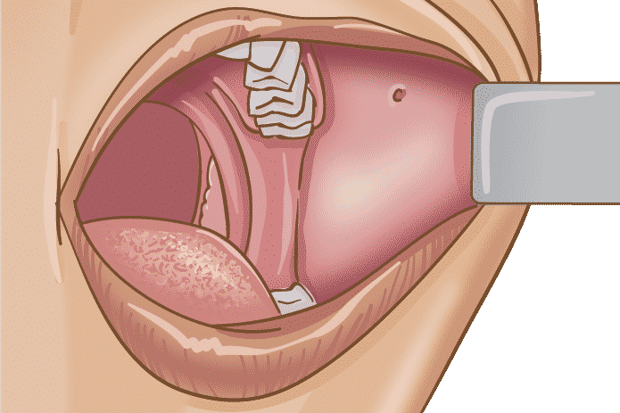 Lav vej minus Tegnsætning Buccal Cancer ‣ Oral Cancers ‣ THANC Guide