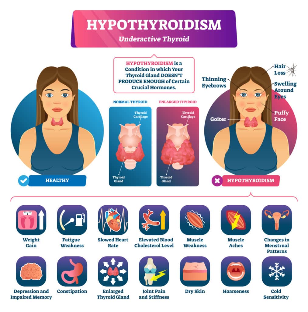 Hypothyroidism - Thyroid