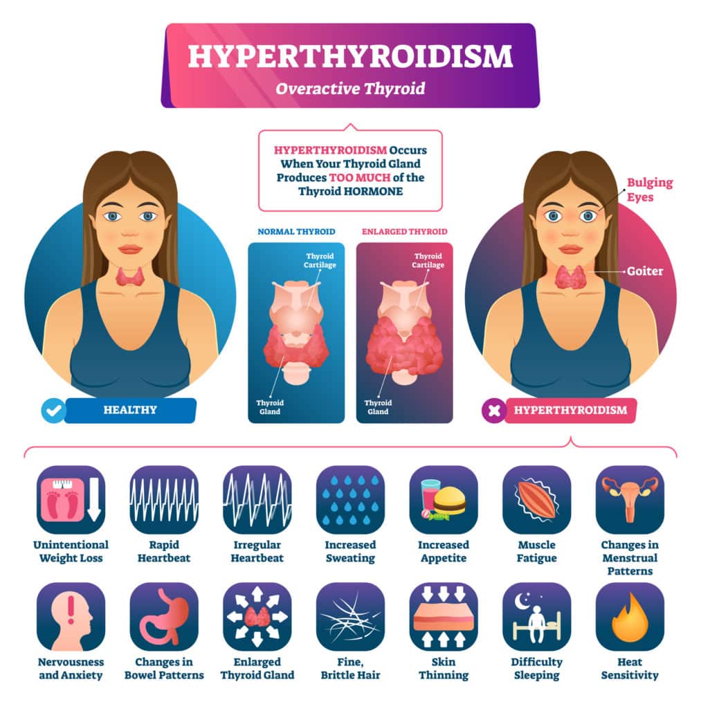 Hipertiroidismo: endocrinóloga explica factores claves de la condición