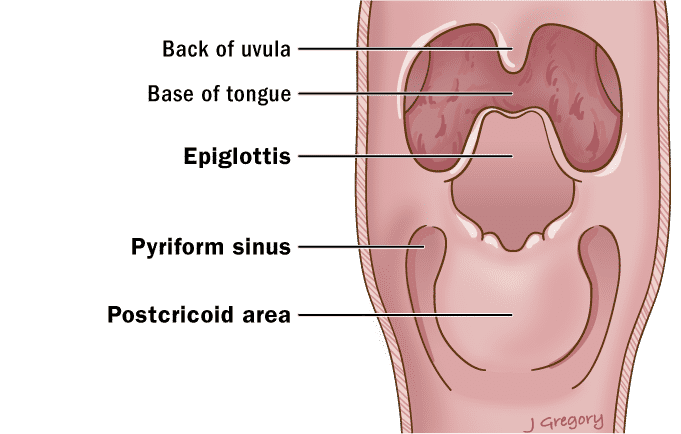 pyriform sinus cancer
