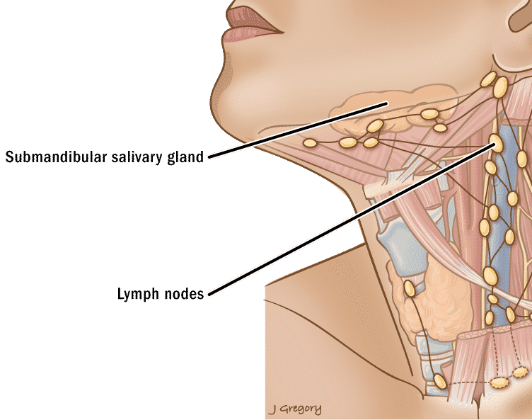 Cáncer de cabeza y cuello - Ganglio linfático